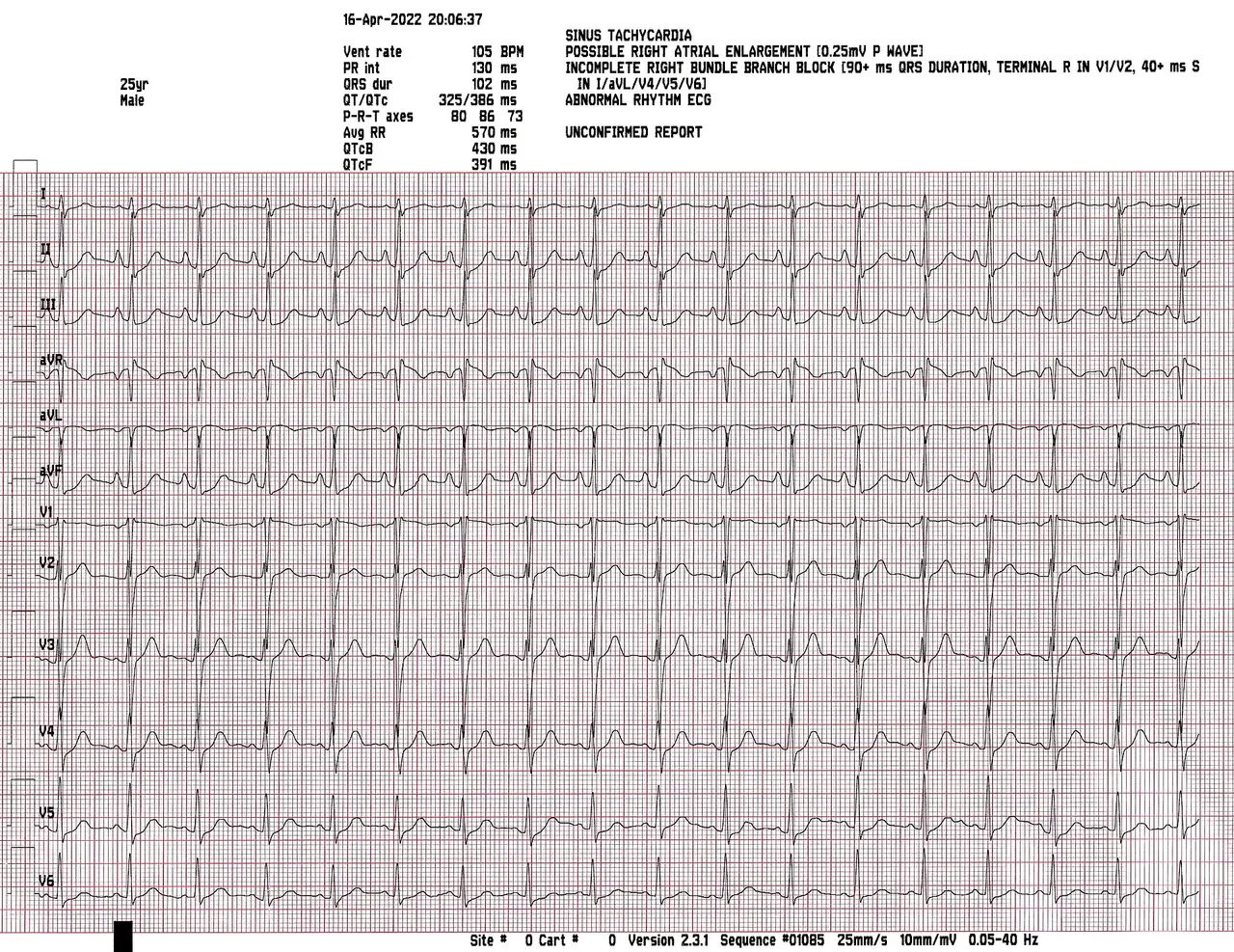 Printed ECG trace on grid paper showing twelve heart rhythm leads