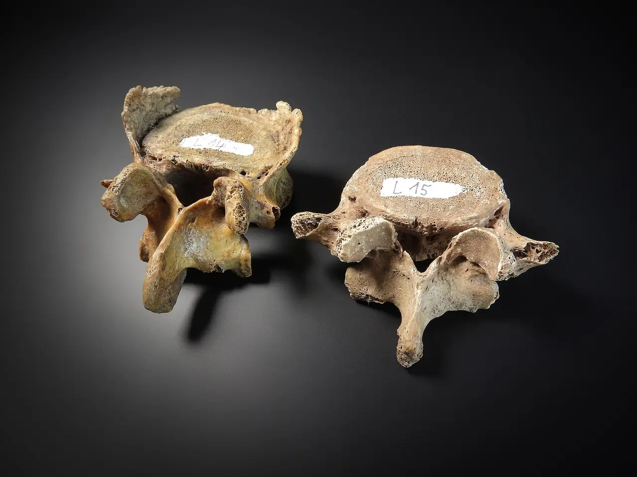 Two lumbar vertebrae lit against a dark grey background
