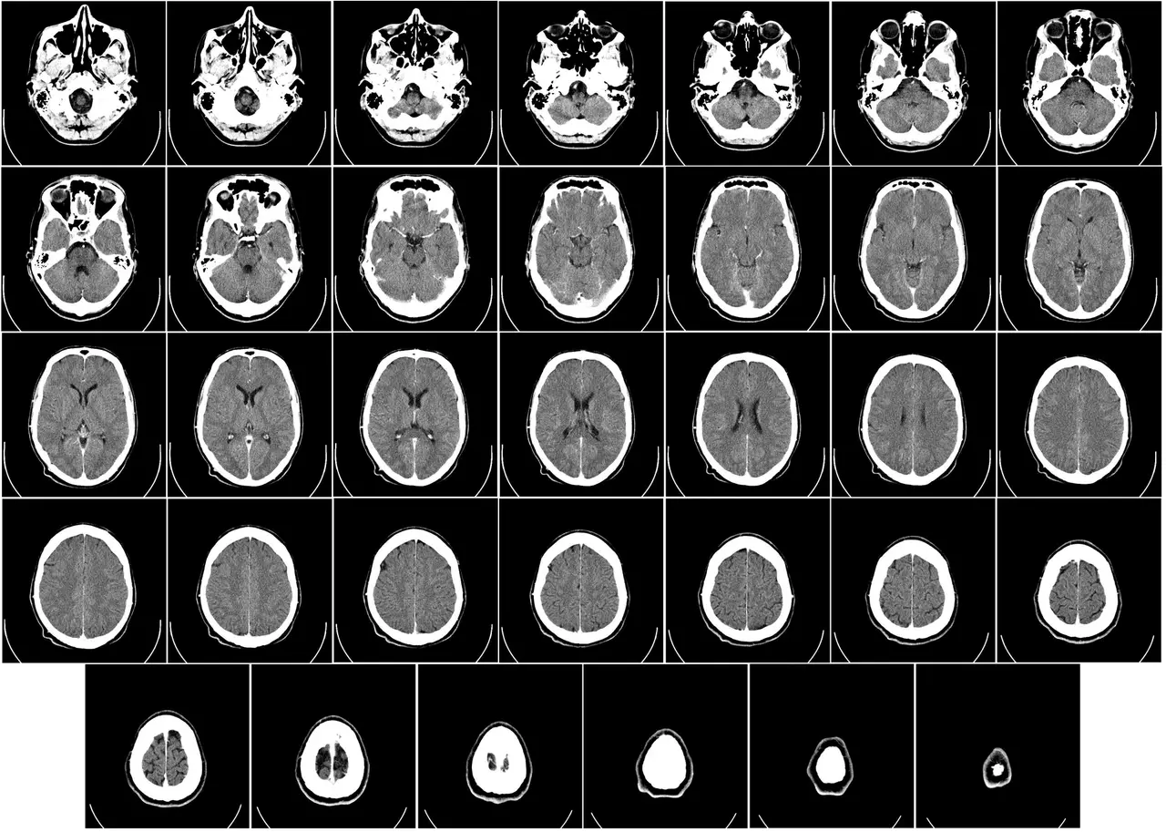 A grid of black and white CT scan slices of a human brain