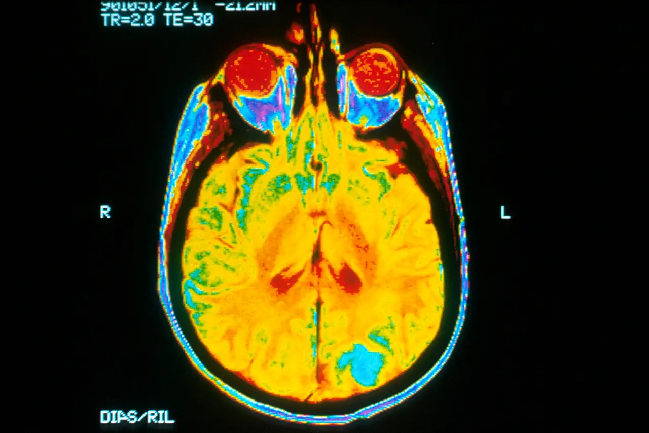 False-colour MRI slice of a human brain and eyes