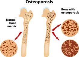 Bone Disease, Osteoporosis, drawing