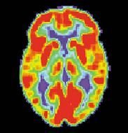 Normal Pet Scan On Brain
