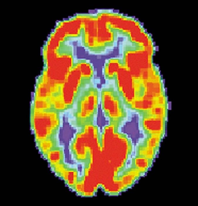 Normal Pet Scan On Brain