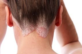 psoriasis on the head