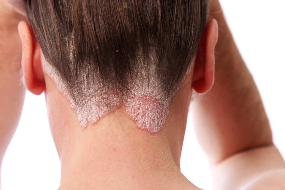 psoriasis on the head