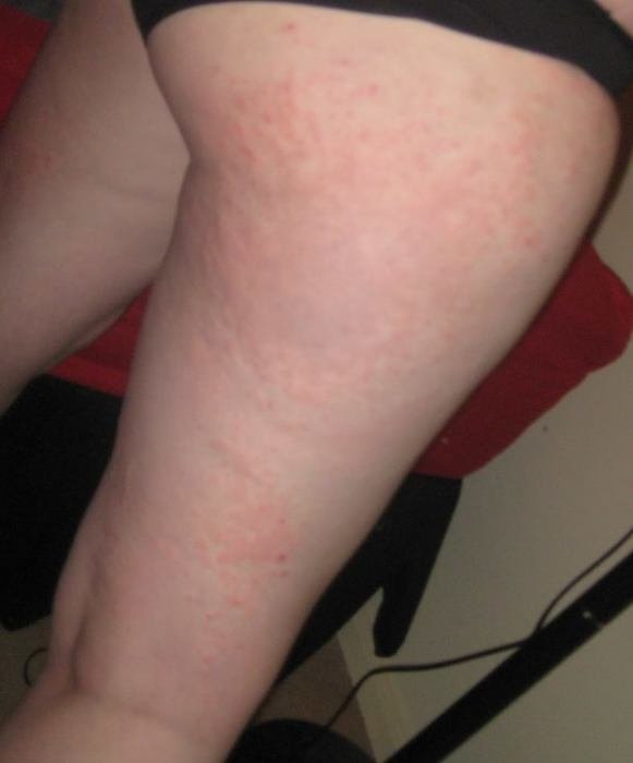fat female leg with skin disease