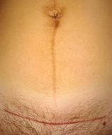 red Section Scar