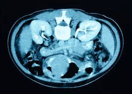 Kidney Transplant Clip Art N6