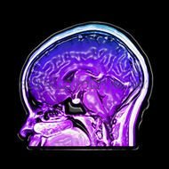 Mri Brain Lesions Pictures Picture