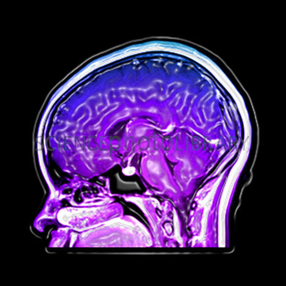 Mri Brain Lesions Pictures Picture