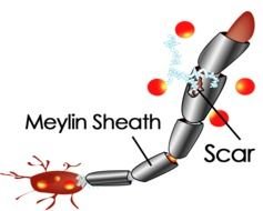 Multiple Sclerosis Myelin Sheath