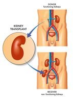 Kidney Transplant drawing