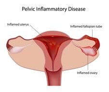 Pelvic Inflammatory Disease In Women as graphic illustration