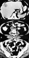CT Scan of Pelvic Lymph Nodes