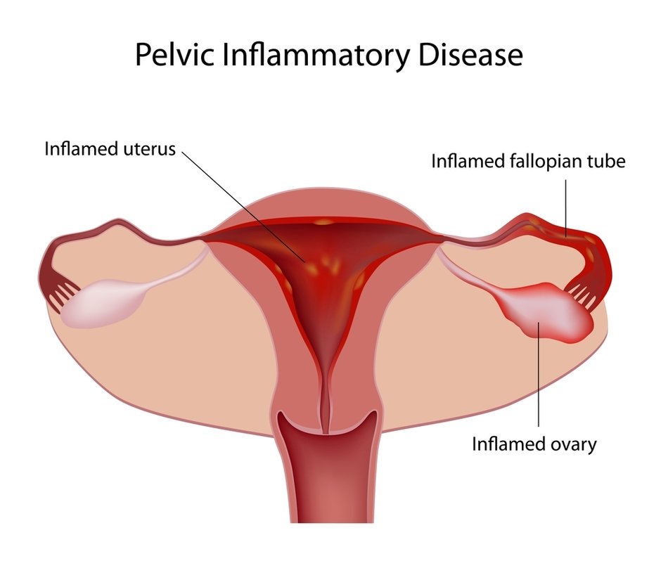 Pelvic Inflammatory Disease In Women as graphic illustration