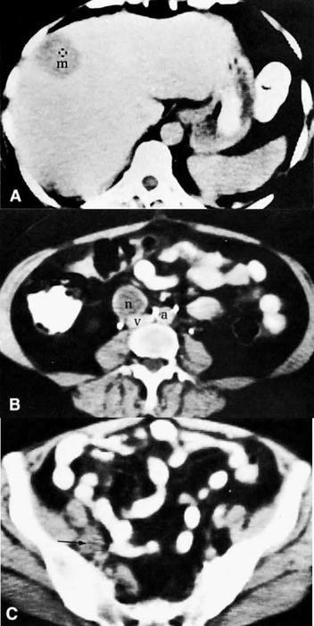 CT Scan of Pelvic Lymph Nodes