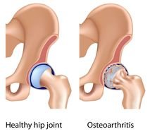 Hip Joint Arthritis