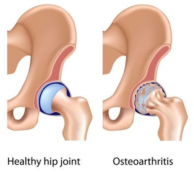 Hip Joint Arthritis