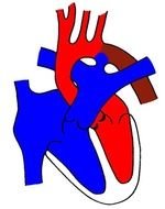 Interrupted Aortic Arch
