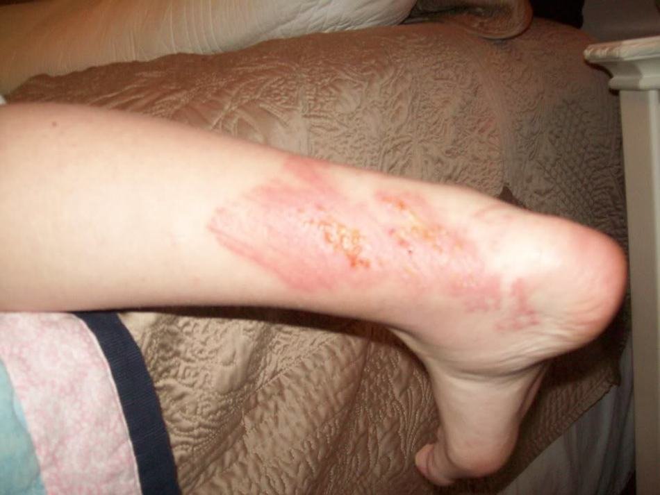 on the leg burns from jellyfish
