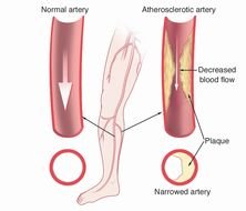 Peripheral Arterial Disease