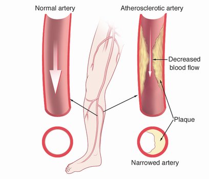 Peripheral Arterial Disease free image download