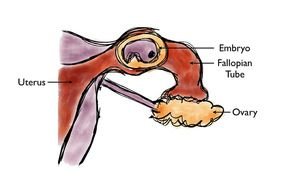 pregnancy stage with one fallopian tube