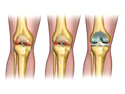 drawn the joint prosthesis