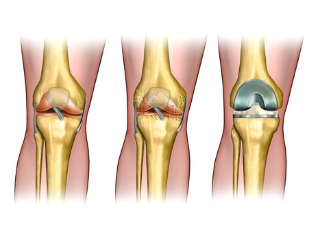 drawn the joint prosthesis