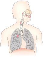 cancer carcinoma metastases drawing