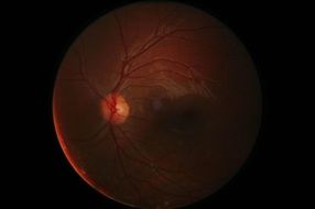 digital retinal photography
