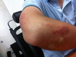 injured man’s elbow