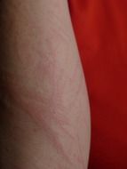 reddening of the skin on a upper arm