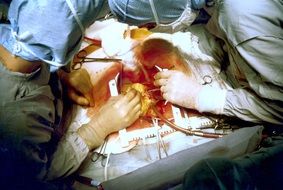 coronary artery bypass grafting