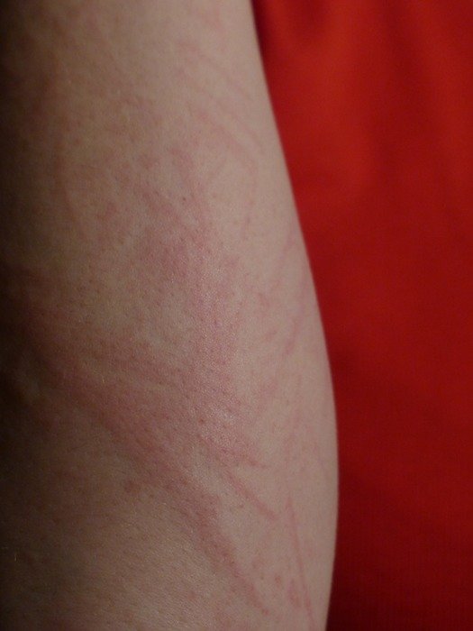 reddening of the skin on a upper arm