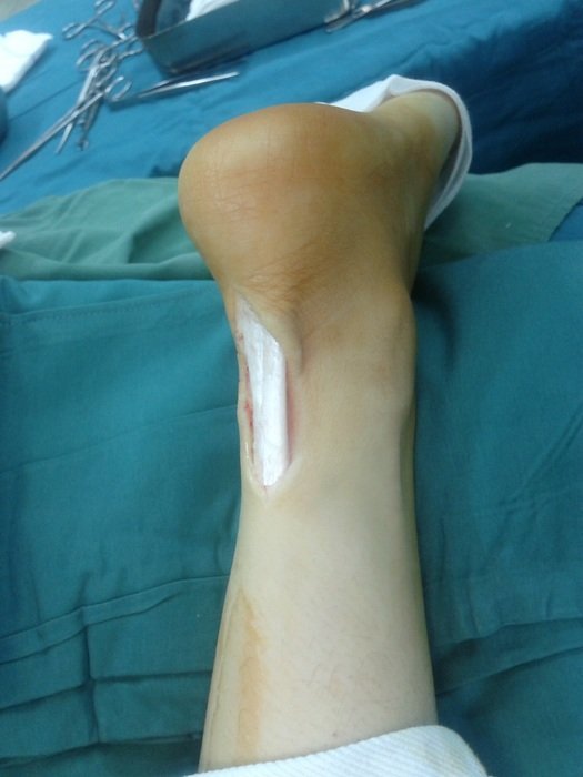 Photo of achilles tendon rupture
