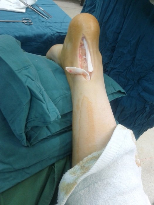 rupture of the Achilles tendon