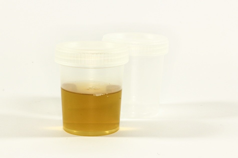 Analysis of urine