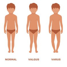 valgus varus knee