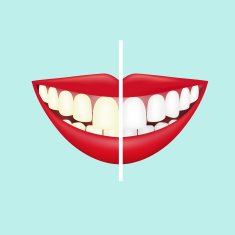 Before and after view of teeth whitening