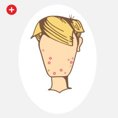 Teenage boy with Acne