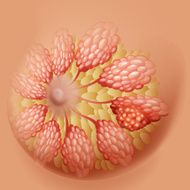 Breast cancer human