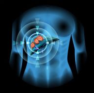 Liver Cancer diagram in human