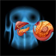 Pancreas cancer diagram in detail