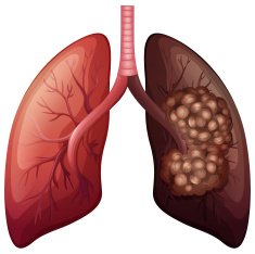 Normal lung cancer