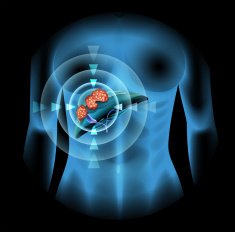 Liver Cancer diagram in human