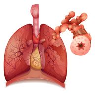 asthma N2
