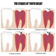 Diagram of tooth with caries stages