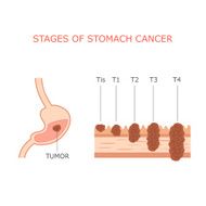 stomach cancer