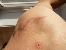 the man has scars on his back